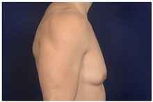 Male Breast Reduction Before Photo by Michael Law, MD; Raleigh, NC - Case 44478