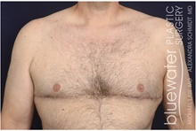 Male Breast Reduction After Photo by Michael Law, MD; Raleigh, NC - Case 44479
