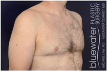 Male Breast Reduction After Photo by Michael Law, MD; Raleigh, NC - Case 44479