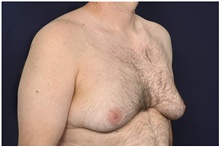 Male Breast Reduction Before Photo by Michael Law, MD; Raleigh, NC - Case 44479