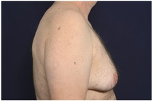 Male Breast Reduction Before Photo by Michael Law, MD; Raleigh, NC - Case 44479