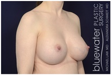 Breast Implant Revision After Photo by Michael Law, MD; Raleigh, NC - Case 44482