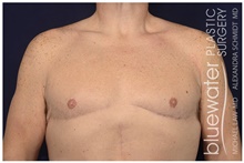 Male Breast Reduction After Photo by Michael Law, MD; Raleigh, NC - Case 44483