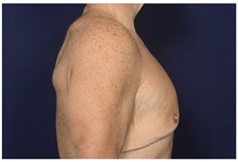 Male Breast Reduction Before Photo by Michael Law, MD; Raleigh, NC - Case 44483