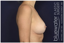 Breast Reduction After Photo by Michael Law, MD; Raleigh, NC - Case 44484