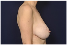 Breast Reduction Before Photo by Michael Law, MD; Raleigh, NC - Case 44484