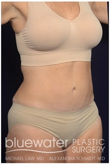 Tummy Tuck After Photo by Michael Law, MD; Raleigh, NC - Case 44485
