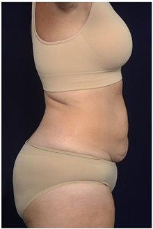 Tummy Tuck Before Photo by Michael Law, MD; Raleigh, NC - Case 44485