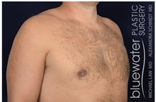 Male Breast Reduction After Photo by Michael Law, MD; Raleigh, NC - Case 44486