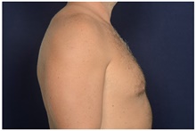 Male Breast Reduction Before Photo by Michael Law, MD; Raleigh, NC - Case 44486