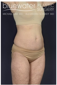 Liposuction After Photo by Michael Law, MD; Raleigh, NC - Case 44488