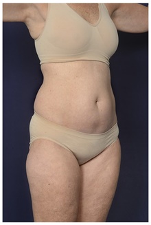 Liposuction Before Photo by Michael Law, MD; Raleigh, NC - Case 44488
