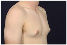 Male Breast Reduction Before Photo by Michael Law, MD; Raleigh, NC - Case 44489