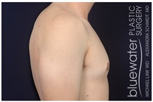 Male Breast Reduction After Photo by Michael Law, MD; Raleigh, NC - Case 44489