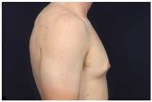 Male Breast Reduction Before Photo by Michael Law, MD; Raleigh, NC - Case 44489