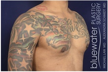 Male Breast Reduction After Photo by Michael Law, MD; Raleigh, NC - Case 44490