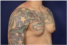 Male Breast Reduction Before Photo by Michael Law, MD; Raleigh, NC - Case 44490