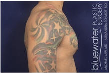 Male Breast Reduction After Photo by Michael Law, MD; Raleigh, NC - Case 44490