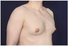 Male Breast Reduction Before Photo by Michael Law, MD; Raleigh, NC - Case 44491