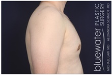Male Breast Reduction After Photo by Michael Law, MD; Raleigh, NC - Case 44491