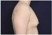 Male Breast Reduction Before Photo by Michael Law, MD; Raleigh, NC - Case 44491