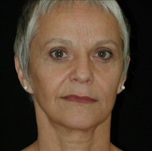 Facelift After Photo by David Kirn, MD; Lexington, KY - Case 24144