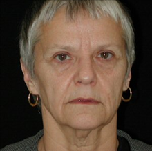 Facelift Before Photo by David Kirn, MD; Lexington, KY - Case 24144