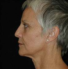 Facelift After Photo by David Kirn, MD; Lexington, KY - Case 24144