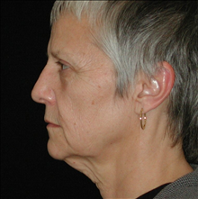 Facelift Before Photo by David Kirn, MD; Lexington, KY - Case 24144
