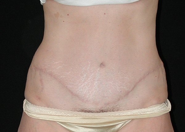 Tummy Tuck Before and After Photos by David Kirn MD Lexington