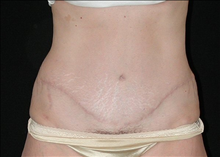 Tummy Tuck After Photo by David Kirn, MD; Lexington, KY - Case 24146