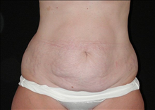 Tummy Tuck Before Photo by David Kirn, MD; Lexington, KY - Case 24146