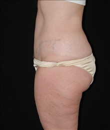 Tummy Tuck After Photo by David Kirn, MD; Lexington, KY - Case 24146
