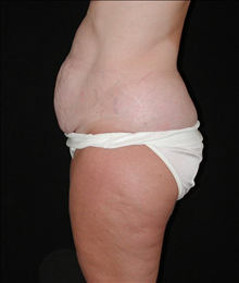 Tummy Tuck Before Photo by David Kirn, MD; Lexington, KY - Case 24146