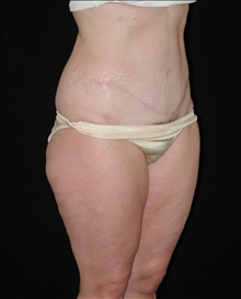 Tummy Tuck After Photo by David Kirn, MD; Lexington, KY - Case 24146