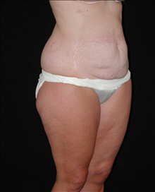 Tummy Tuck Before Photo by David Kirn, MD; Lexington, KY - Case 24146