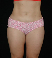 Liposuction After Photo by David Kirn, MD; Lexington, KY - Case 24149