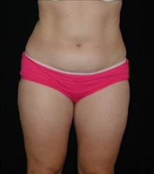 Liposuction Before Photo by David Kirn, MD; Lexington, KY - Case 24149