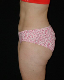 Liposuction After Photo by David Kirn, MD; Lexington, KY - Case 24149
