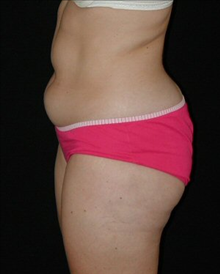 Liposuction Before Photo by David Kirn, MD; Lexington, KY - Case 24149