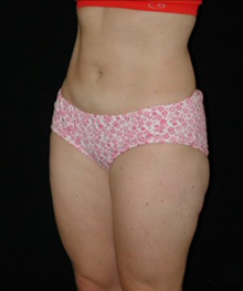 Liposuction After Photo by David Kirn, MD; Lexington, KY - Case 24149