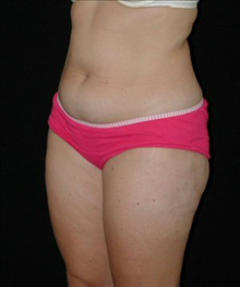 Liposuction Before Photo by David Kirn, MD; Lexington, KY - Case 24149