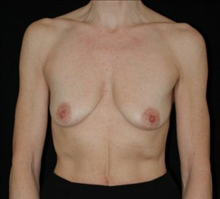 Breast Augmentation Before Photo by David Kirn, MD; Lexington, KY - Case 24150