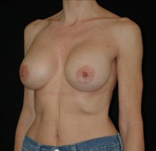 Breast Augmentation After Photo by David Kirn, MD; Lexington, KY - Case 24150