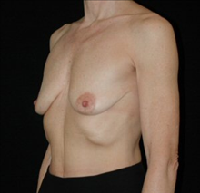 Breast Augmentation Before Photo by David Kirn, MD; Lexington, KY - Case 24150