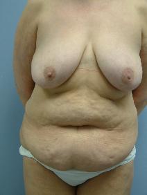 Tummy Tuck Before Photo by Deborah Sillins, MD; Hebron, KY - Case 7142