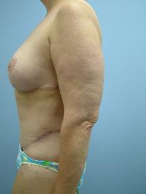 Tummy Tuck After Photo by Deborah Sillins, MD; Hebron, KY - Case 7142