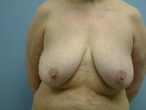 Breast Reduction Before Photo by Deborah Sillins, MD; Hebron, KY - Case 7143