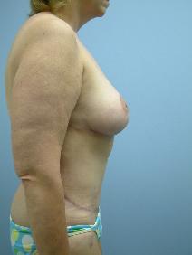 Breast Reduction After Photo by Deborah Sillins, MD; Hebron, KY - Case 7143