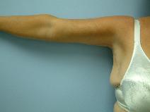 Body Contouring After Photo by Deborah Sillins, MD; Hebron, KY - Case 7148